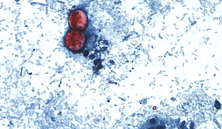U.S. up to 1,645 cases of domestically contracted cyclosporiasis since May